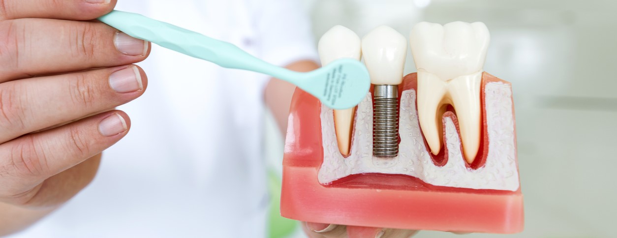 The Remarkable Benefits of Dental Implants in Adelaide