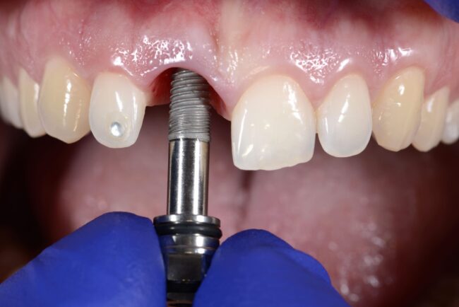 a mouth with a tooth for a dental implant
