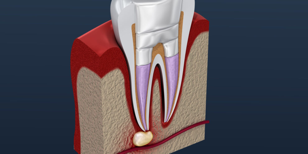 Dental fillings procedure diagramm . 3D illustration