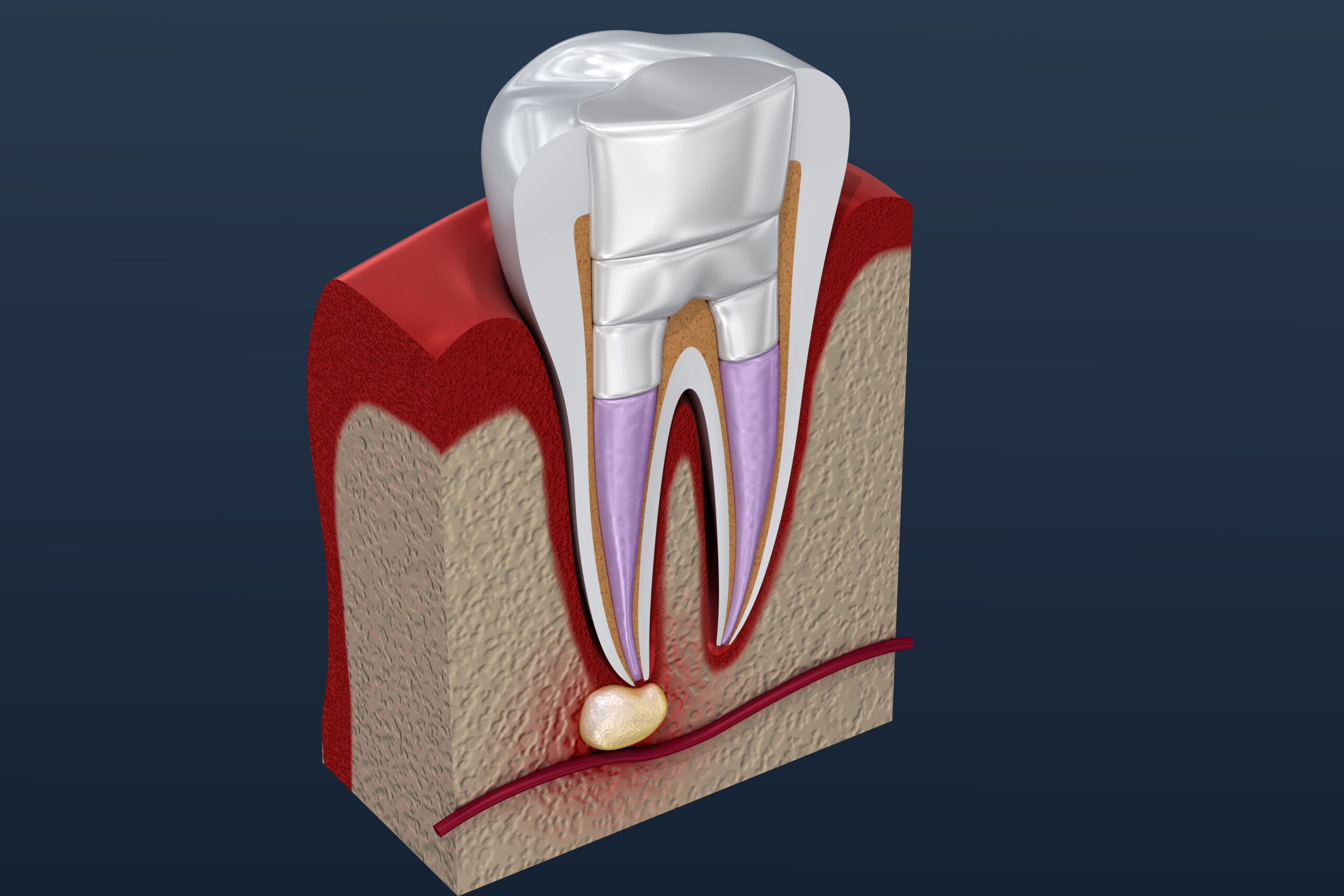 Dental fillings procedure diagramm . 3D illustration Dental fillings procedure diagramm . 3D illustration