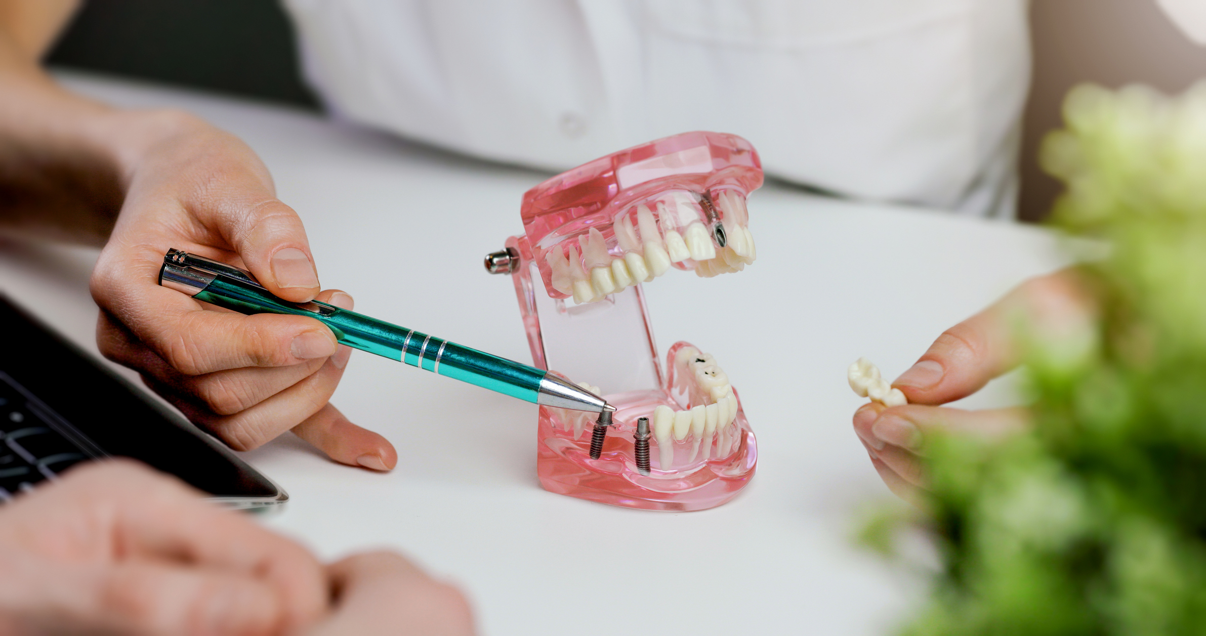 A high-quality dental implant assembly showing the titanium post, abutment, and natural-looking porcelain crown.